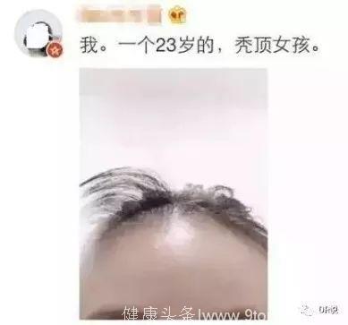 头发一抓掉一把？一大波90后迎来人生的颜值危机——脱发！