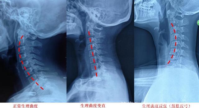 颈椎反弓关系重大，生活细节不可忽视