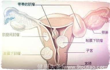 子宫内膜越薄越不容易怀孕，想要受孕的宝妈们，可别再做人流了