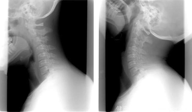 颈椎不适可能引发6大问题！这些“伤颈事”多数人都做过