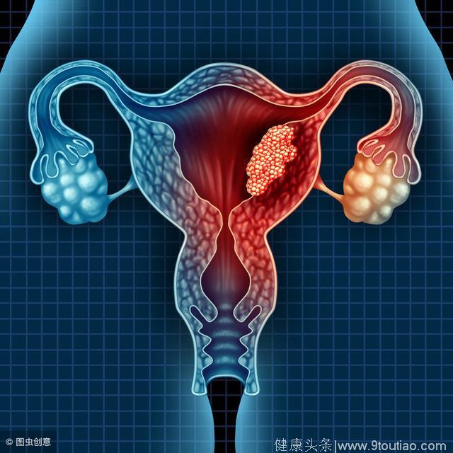 子宫内膜癌癌变之前有哪些症状呢