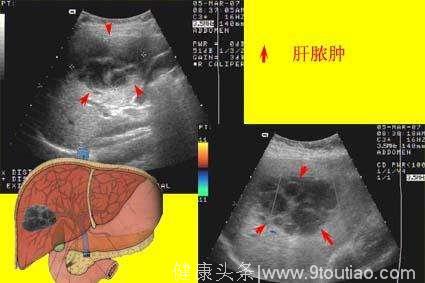 肝病入门：肝病就是肝炎的认识偏差！