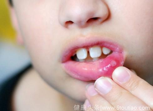 孩子口腔溃疡老不好，原来是身体里缺了它，长期缺乏会影响智力！