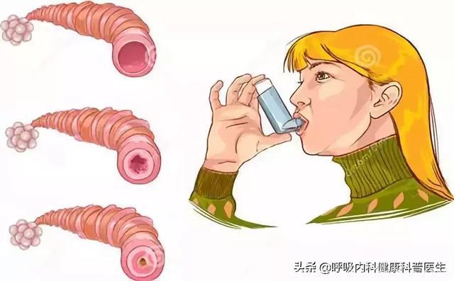 哮喘不发作你就当没事？哮喘是如何发生的，哮喘的最佳治疗方法