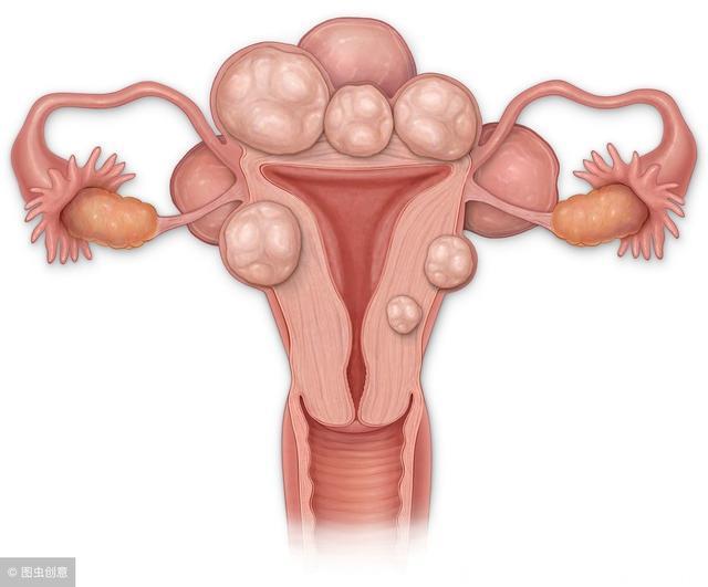 腹部肿物可能是子宫肌瘤“出现”了