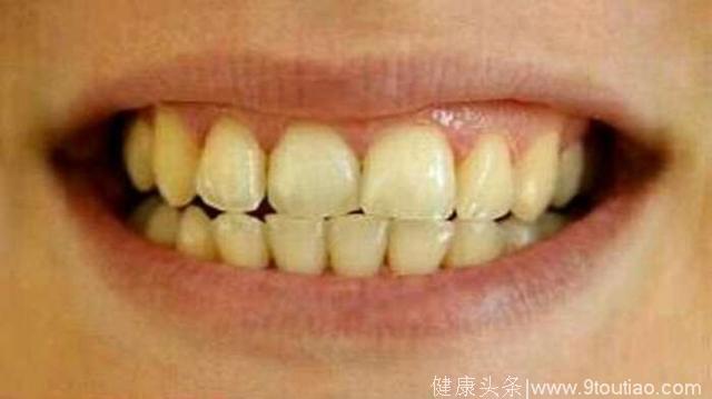 牙齿上的“黄泥”还有点臭，为什么？怎么预防，一篇文章都说清明