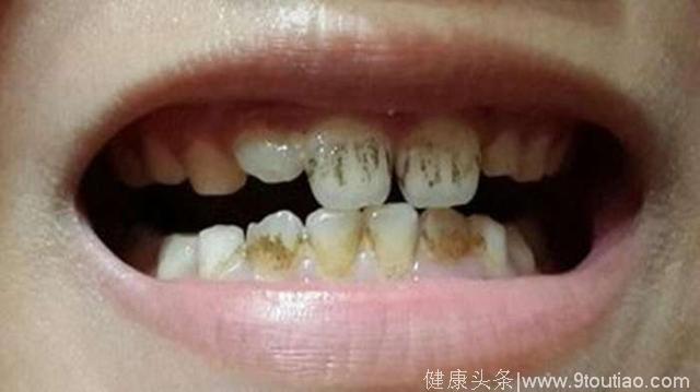 牙齿上的“黄泥”还有点臭，为什么？怎么预防，一篇文章都说清明