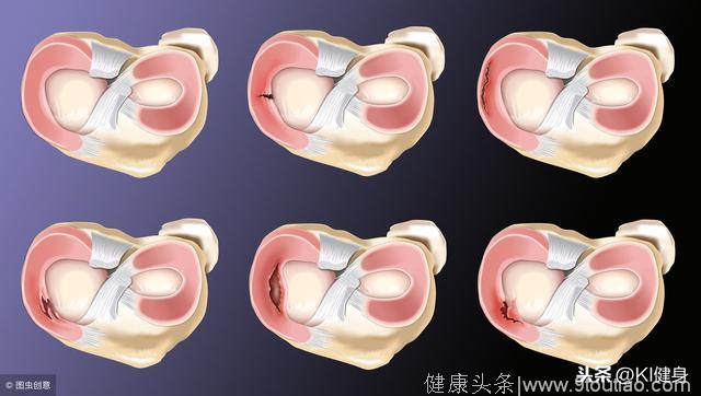 膝关节半月板损伤