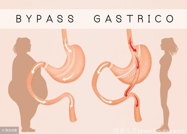 为什么胃旁路手术可以快速减肥治疗糖尿病？因为促进GLP-1释放