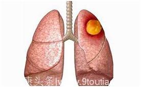 四种肺病容易与肺癌混淆