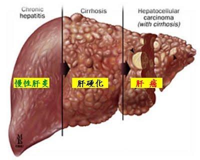 肝癌发生前的4个信号，很多人不重视!医生：护肝这4种食物很关键