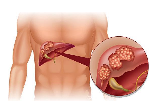 肝癌发生前的4个信号，很多人不重视!医生：护肝这4种食物很关键