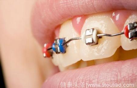 春节期间涨涨口腔姿势：做个牙齿矫正为啥会这么贵？
