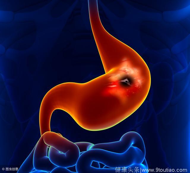 胃炎一开始就很痛，为什么胃癌晚期才有感觉？如何早期发现胃癌