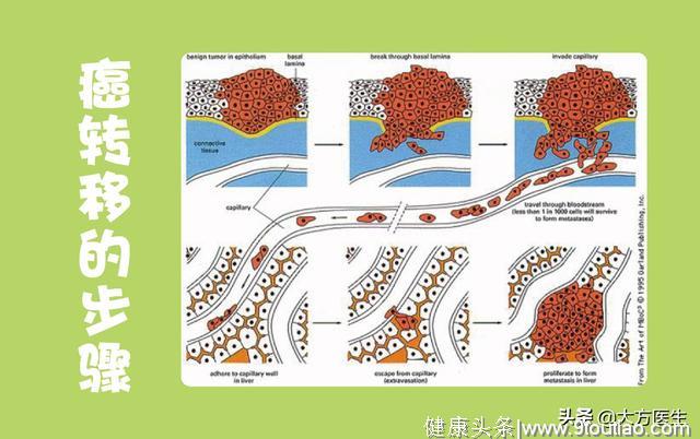 清风计划 手术切除肿瘤之后，癌症就痊愈了？