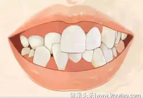 12岁前必须处理的12种儿童牙颌畸形