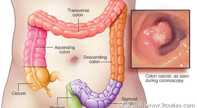 他身体出现了这些症状，但却没当回事，再检查就是肠癌晚期！