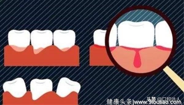 不洗牙，小心牙周炎吃掉你骨头