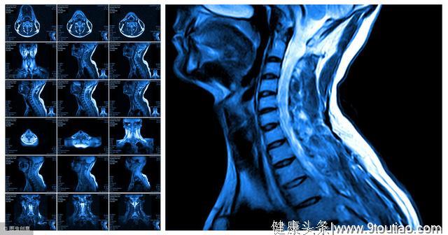 求医不如求己，颈椎病康复的办法是抻筋拔骨，恢复气血运行