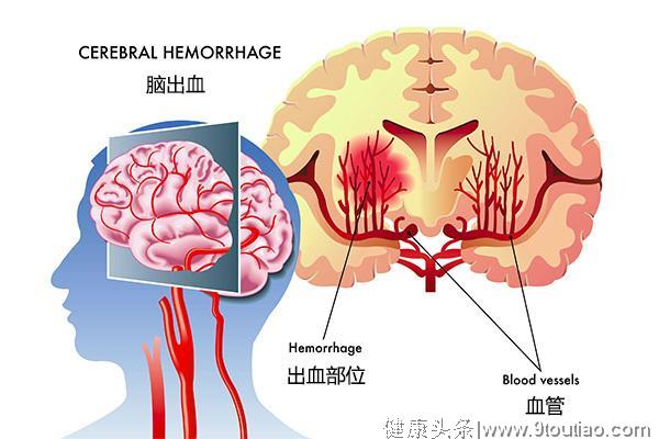 高血压性脑出血是如何发生的？