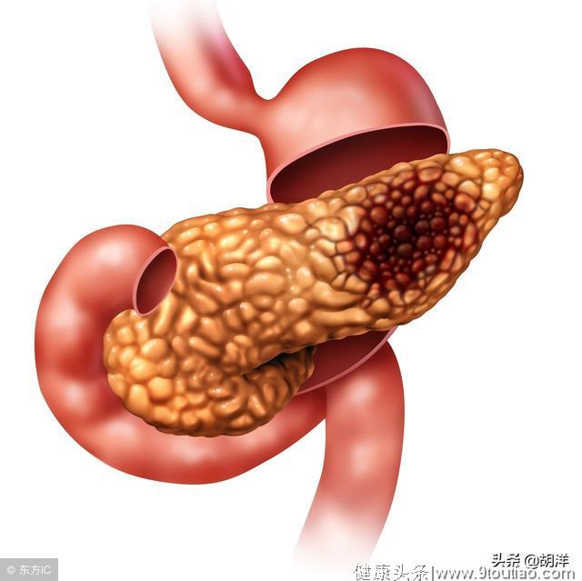 胰腺癌俗称癌王，如何早期诊断，医生总结这六点，早发现活得长