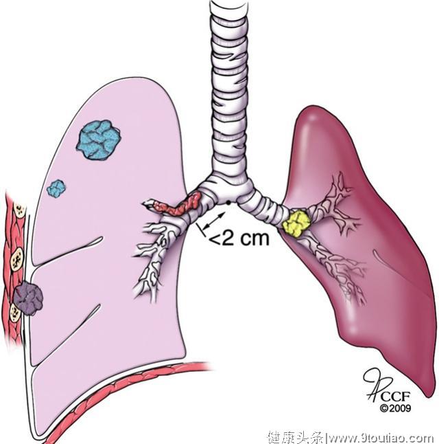 肺癌术后一定要化疗吗？明白了这些你就知道有些其实不需要