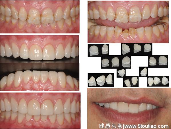 牙齿有缺陷，笑不出来？超薄瓷贴面美学修复，重现美丽自信的笑容