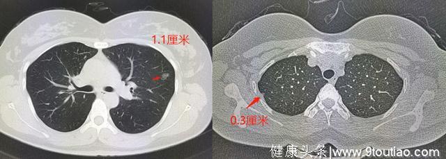 年轻人得了肺癌更可怕？要看显微镜下丑不丑，医生喜欢磨玻璃结节