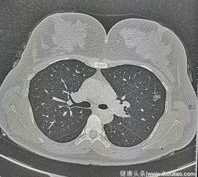 年轻人得了肺癌更可怕？要看显微镜下丑不丑，医生喜欢磨玻璃结节