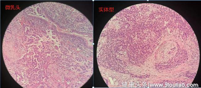 年轻人得了肺癌更可怕？要看显微镜下丑不丑，医生喜欢磨玻璃结节