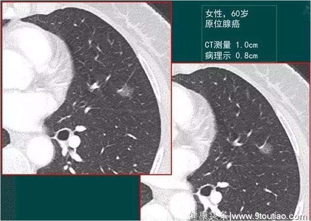 年轻人得了肺癌更可怕？要看显微镜下丑不丑，医生喜欢磨玻璃结节