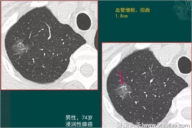 年轻人得了肺癌更可怕？要看显微镜下丑不丑，医生喜欢磨玻璃结节