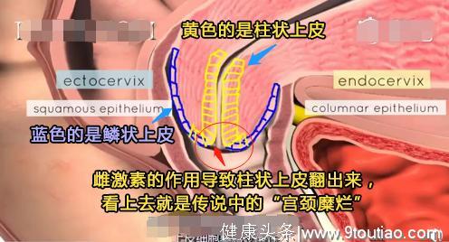 妇科医生告诉你，宫颈癌与宫颈糜烂的区别及如何预防