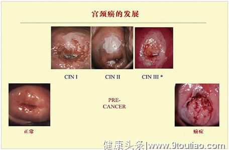 妇科医生告诉你，宫颈癌与宫颈糜烂的区别及如何预防