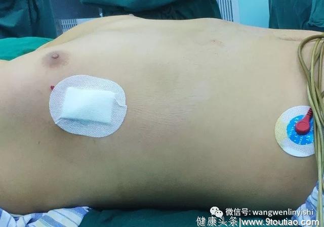 在福建完成的漏斗胸Bleedingless手术