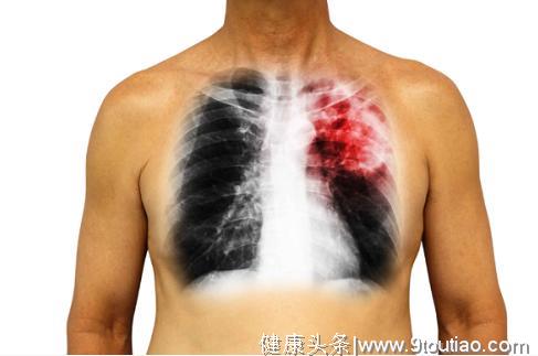 肺癌早期的5大症状你应了解，及早发现能救命！