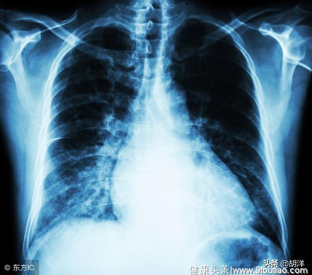 什么样的肺癌最容易被根治，当然是Ia期肺癌，那什么是Ia期肺癌