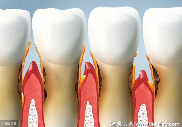 7个症状告诉你牙周不健康，糖尿病患者更需注意“牙齿危机”！