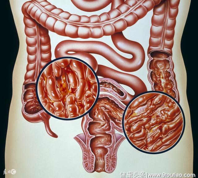 为什么你的小孩经常腹泻？可能是“它”惹的祸！