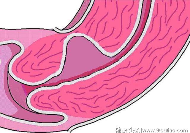 子宫疤痕憩室再次修补该怎么办？