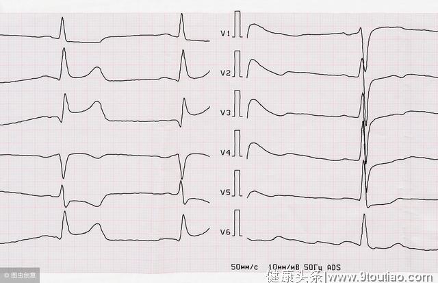 六项注意防心肌梗塞，也防心脏骤停