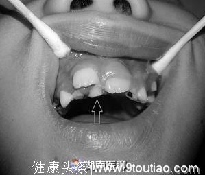 “双排牙”影响孩子咀嚼、语音功能？医生：科学预防这四点要牢记