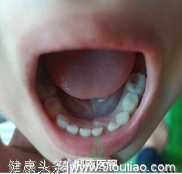 “双排牙”影响孩子咀嚼、语音功能？医生：科学预防这四点要牢记