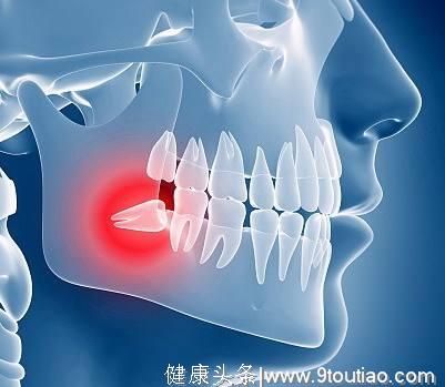 为了防止智齿冠周炎在春节后找上门，赶紧把它拔了吧！