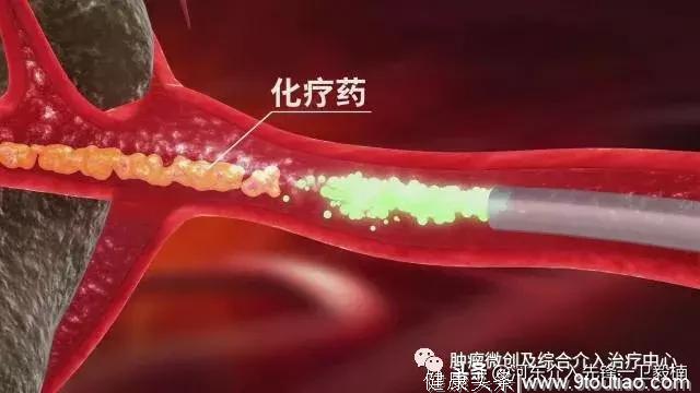 胰腺癌的诊断+微创介入治疗