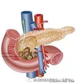 胰腺癌的诊断+微创介入治疗