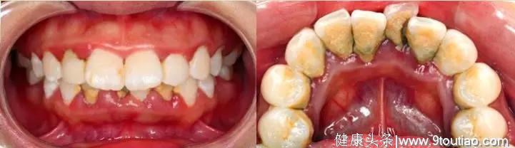 杭州22岁女大学生牙齿上长满 “苔藓”！竟和她“不会”刷牙有关