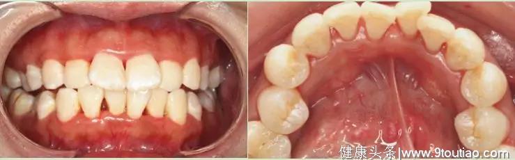 杭州22岁女大学生牙齿上长满 “苔藓”！竟和她“不会”刷牙有关