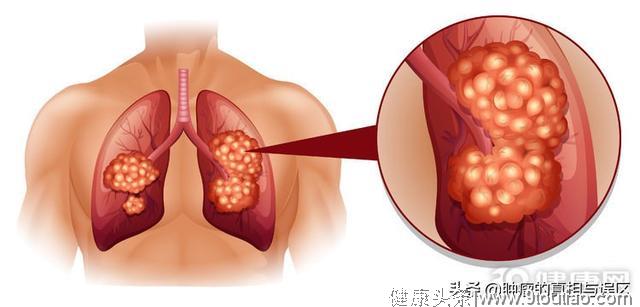 女人也会得肺癌？看来这4件事，她一个都没做