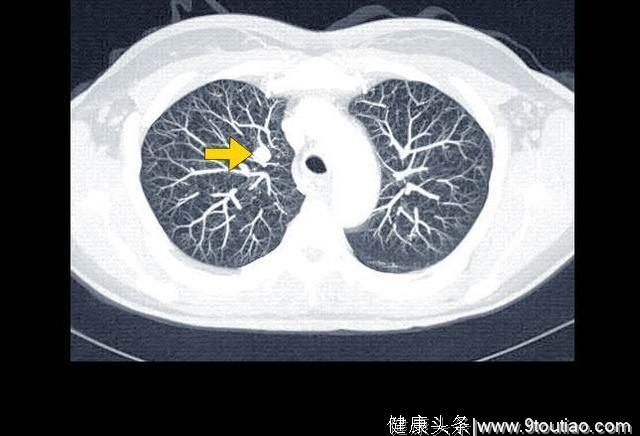 发病率第一的肺癌，怎么才能早期发现？这个医生说的很清楚